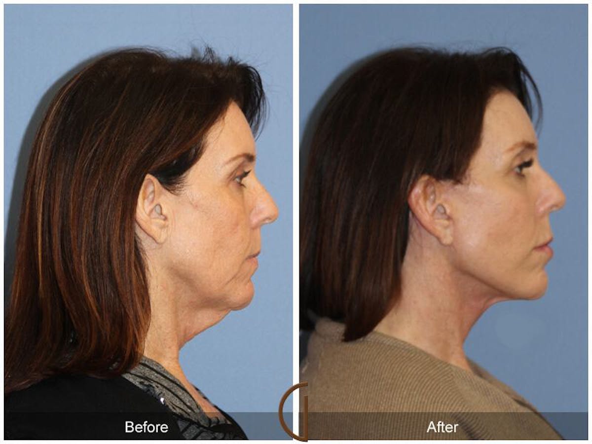 Facelift 50s Before & After Gallery - Patient 412124 - Image 3