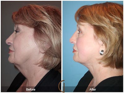 Neck Lift Before & After Gallery - Patient 387867 - Image 1