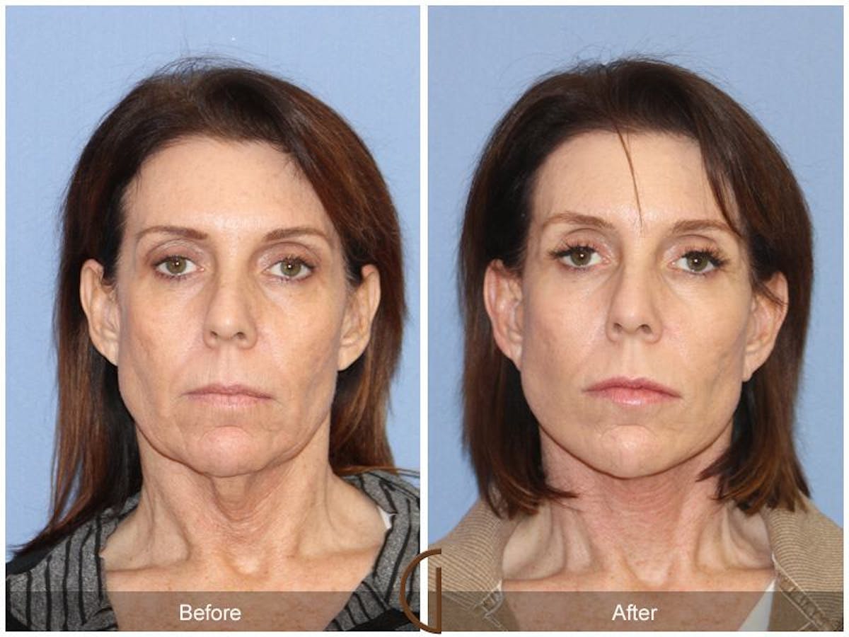 Facelift 50s Before & After Gallery - Patient 412124 - Image 2
