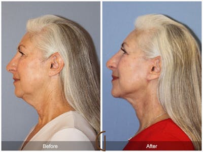 Neck Lift Before & After Gallery - Patient 120620 - Image 1