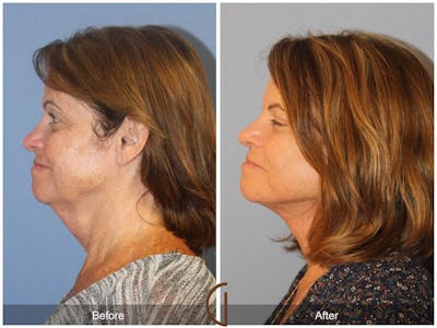 Neck Lift Before & After Gallery - Patient 387908 - Image 1
