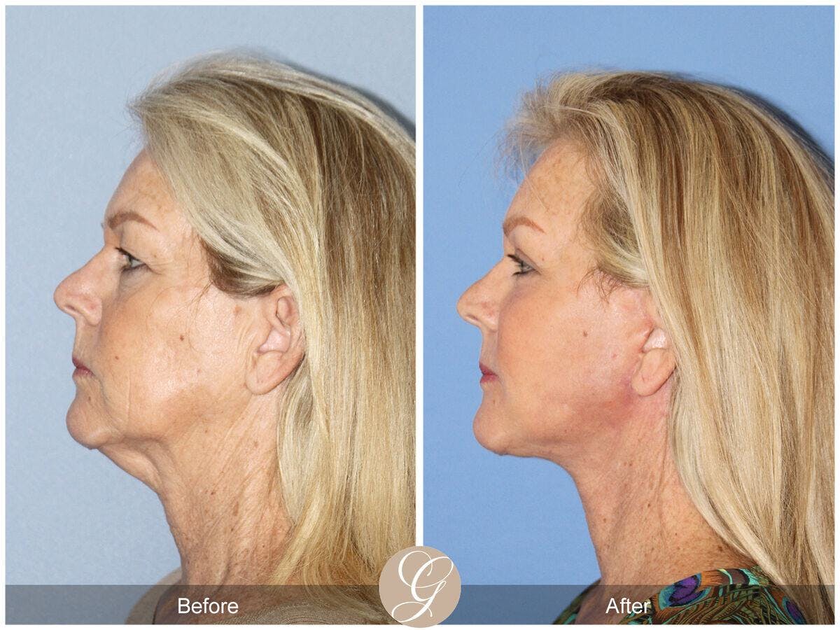 Facelift 60s Before & After Gallery - Patient 264819 - Image 1