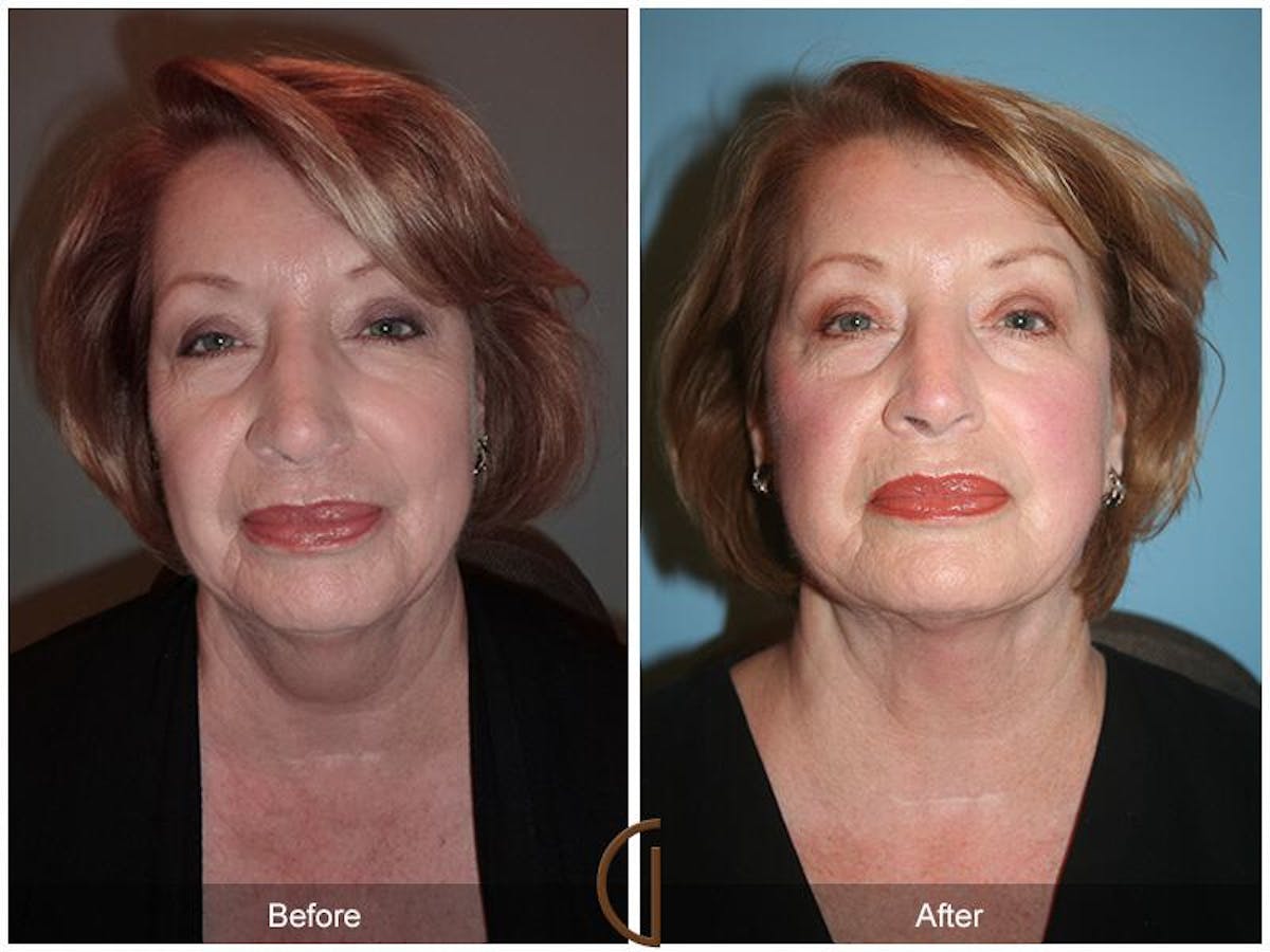 Facelift 60s Before & After Gallery - Patient 310414 - Image 2