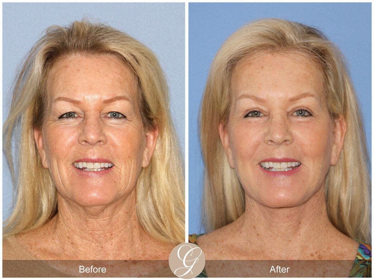 Facelift 60s Before & After Gallery - Patient 264819 - Image 2