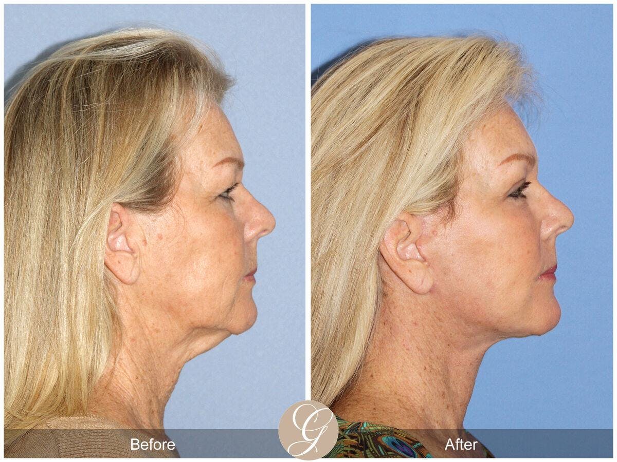 Facelift 60s Before & After Gallery - Patient 264819 - Image 3