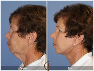 Neck Lift Before & After Gallery - Patient 654745 - Image 1