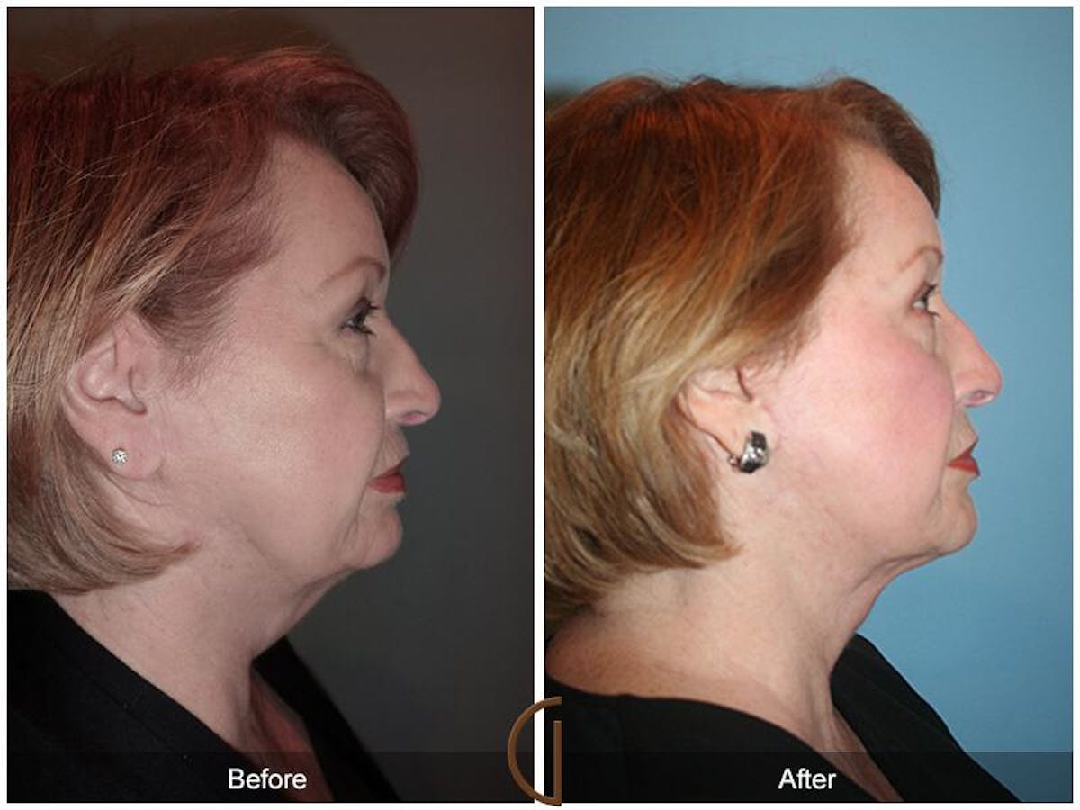 Facelift 60s Before & After Gallery - Patient 310414 - Image 3