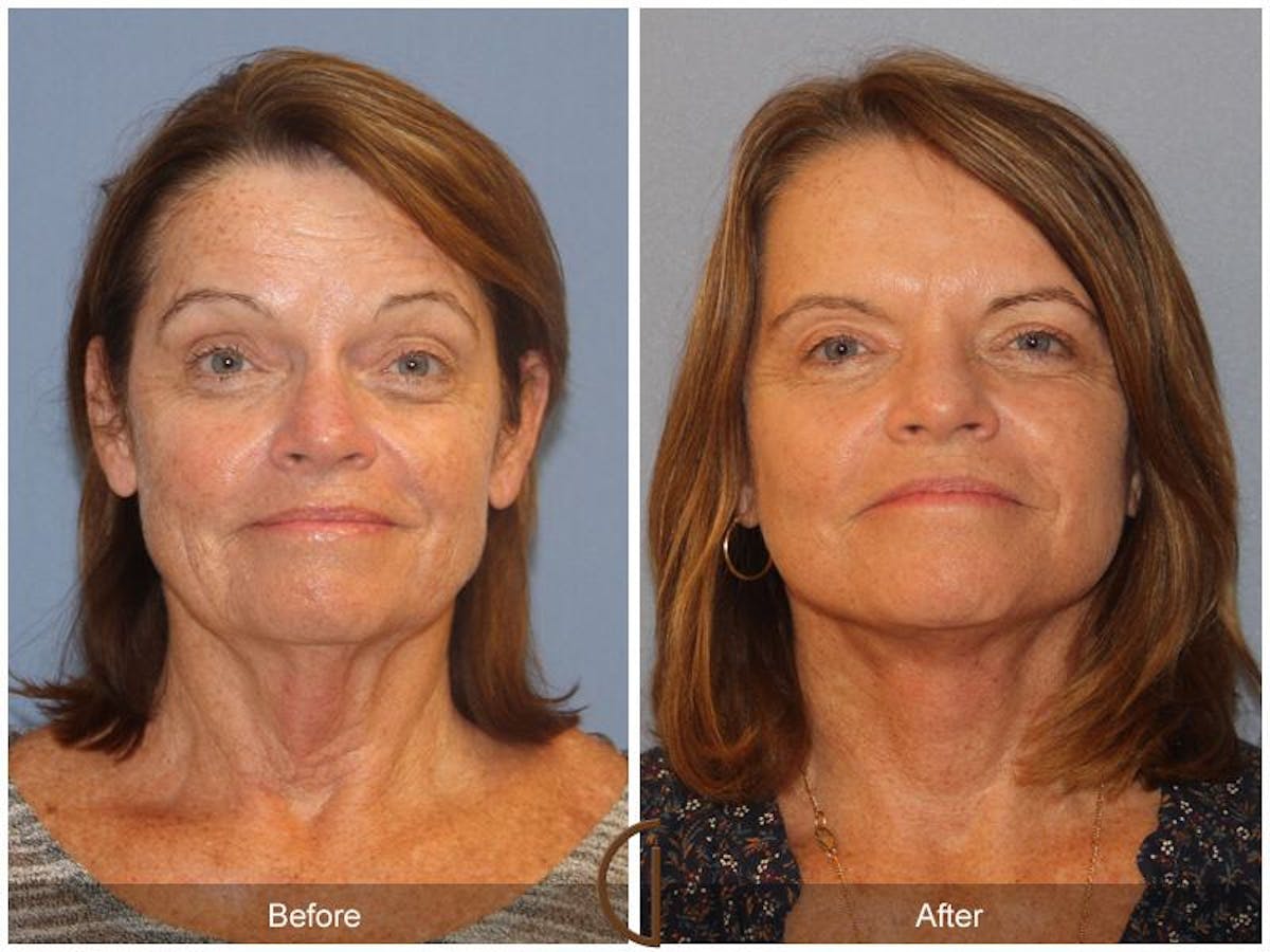 Facelift 60s Before & After Gallery - Patient 420234 - Image 2