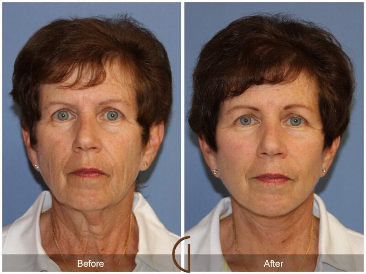 Facelift 60s Before & After Gallery - Patient 228507 - Image 2