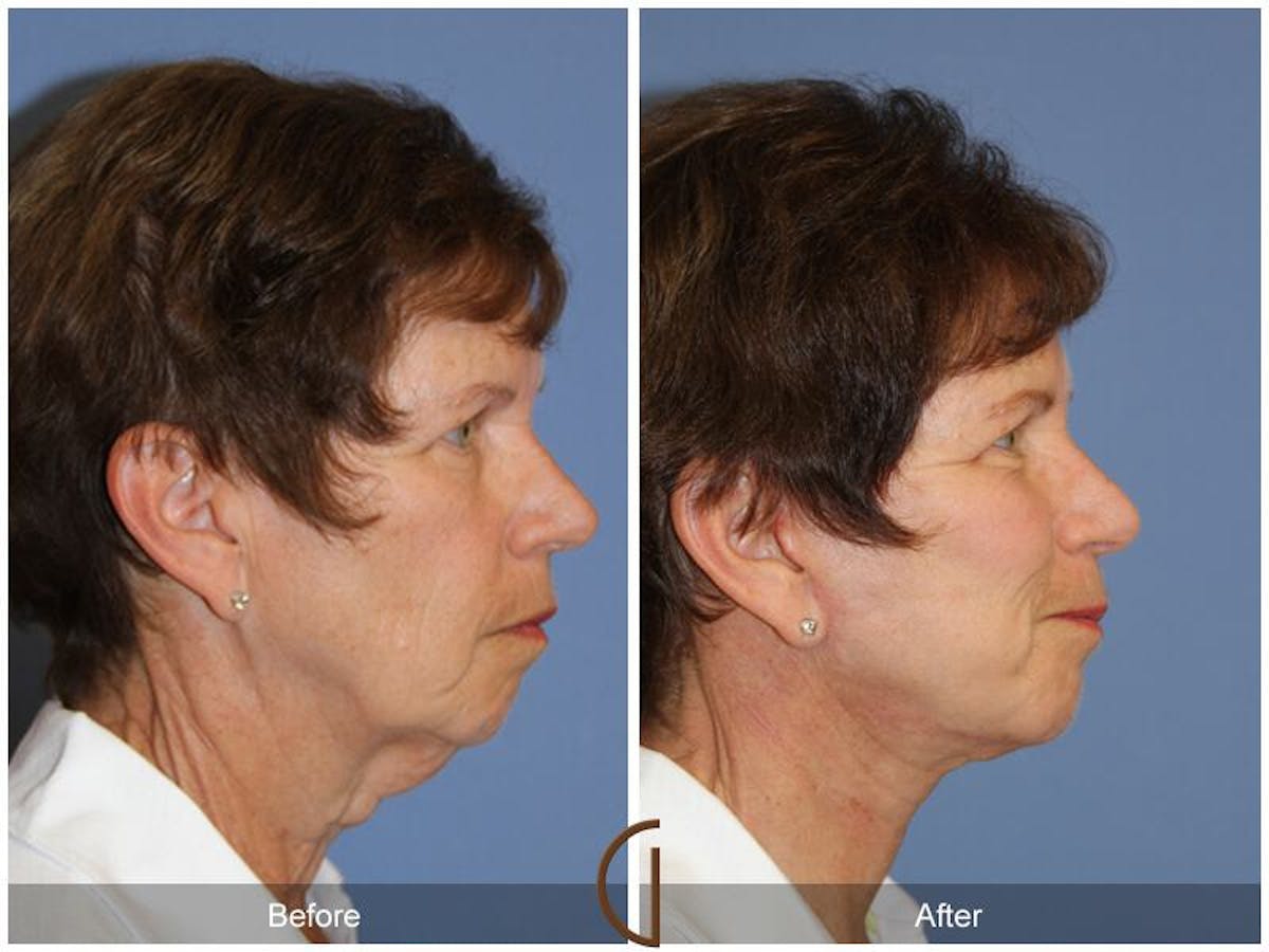 Facelift 60s Before & After Gallery - Patient 228507 - Image 3