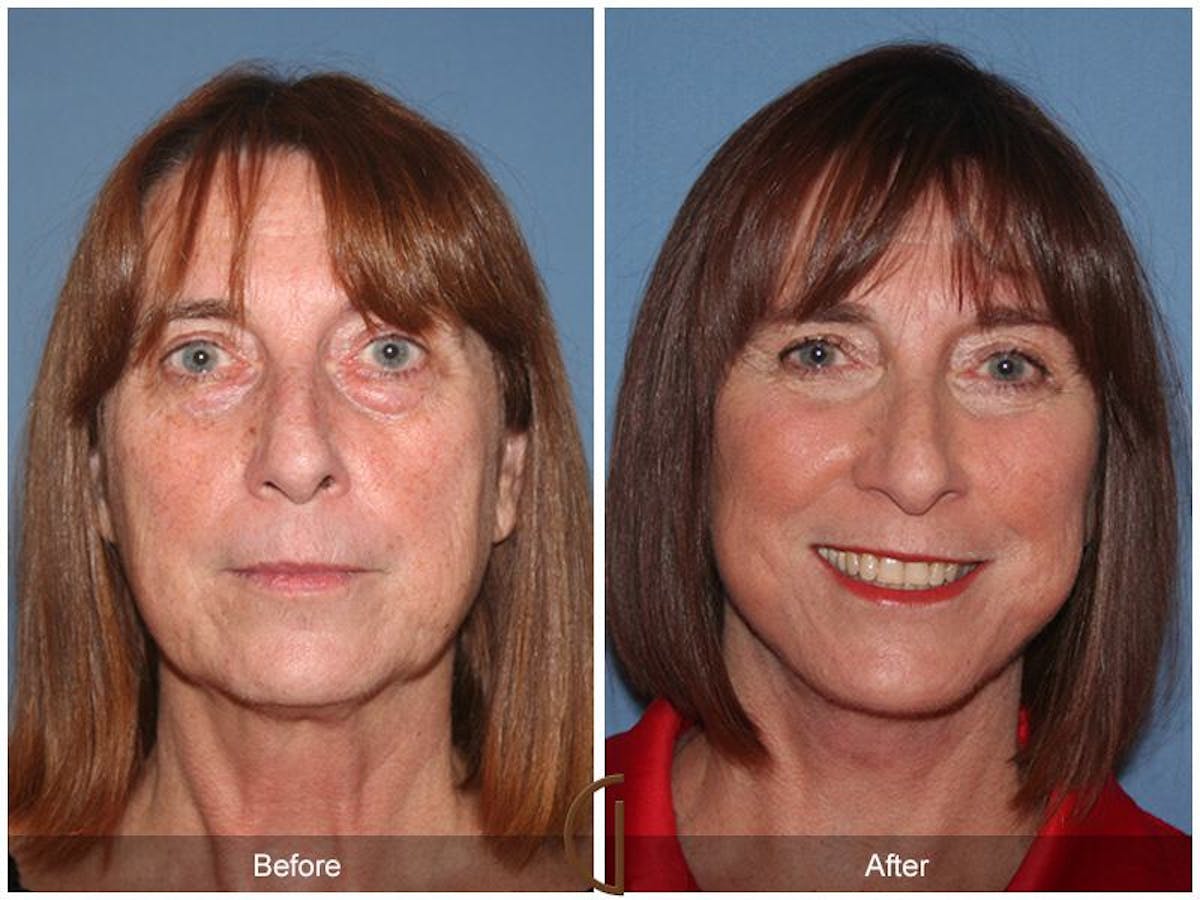 Facelift 60s Before & After Gallery - Patient 199819 - Image 2