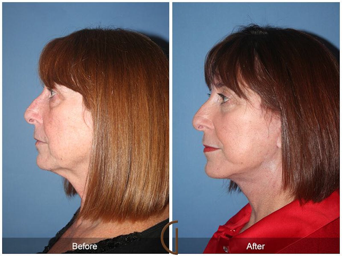 Facelift 60s Before & After Gallery - Patient 199819 - Image 1
