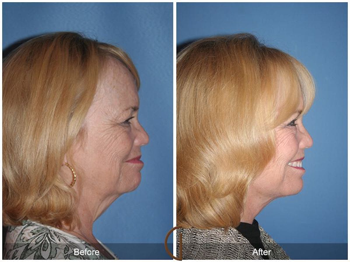 Facelift 60s Before & After Gallery - Patient 208533 - Image 3