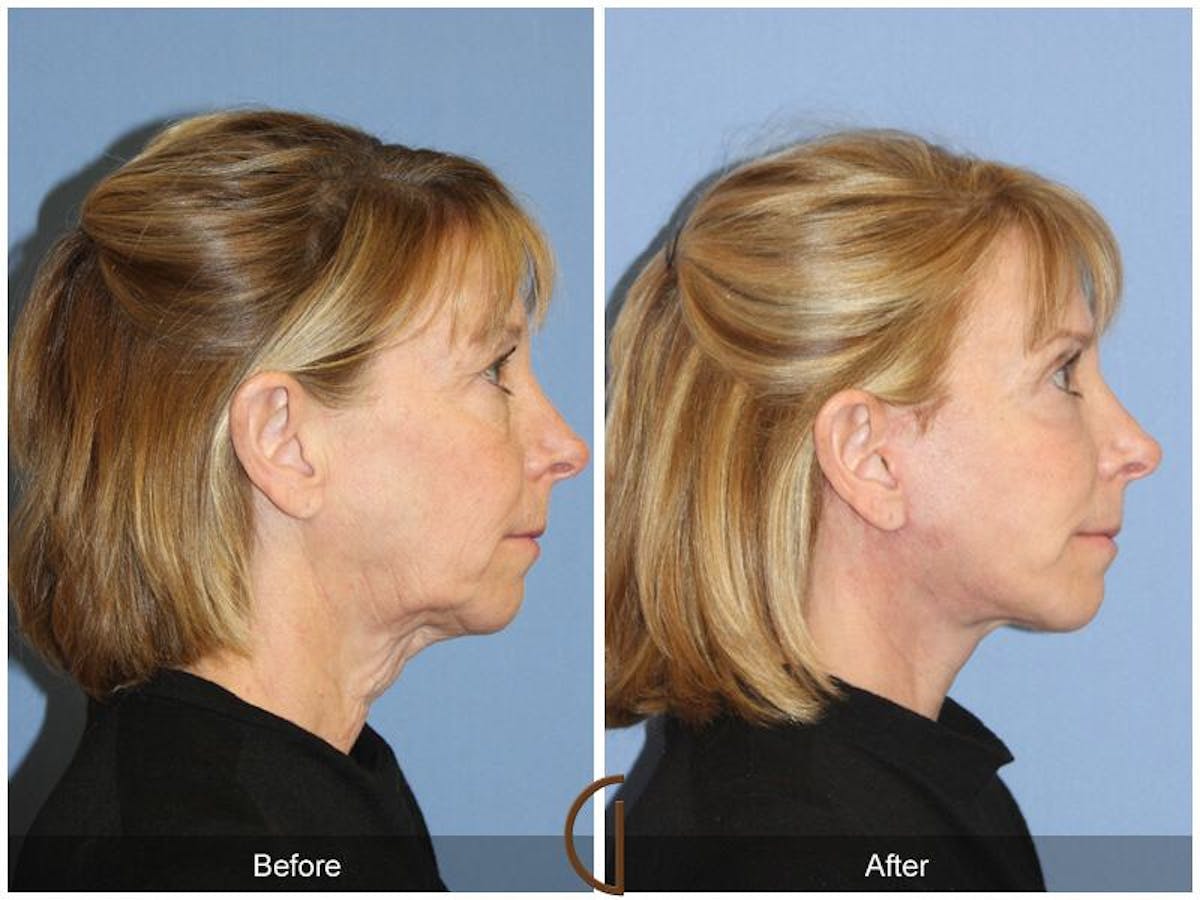 Facelift 60s Before & After Gallery - Patient 188895 - Image 3