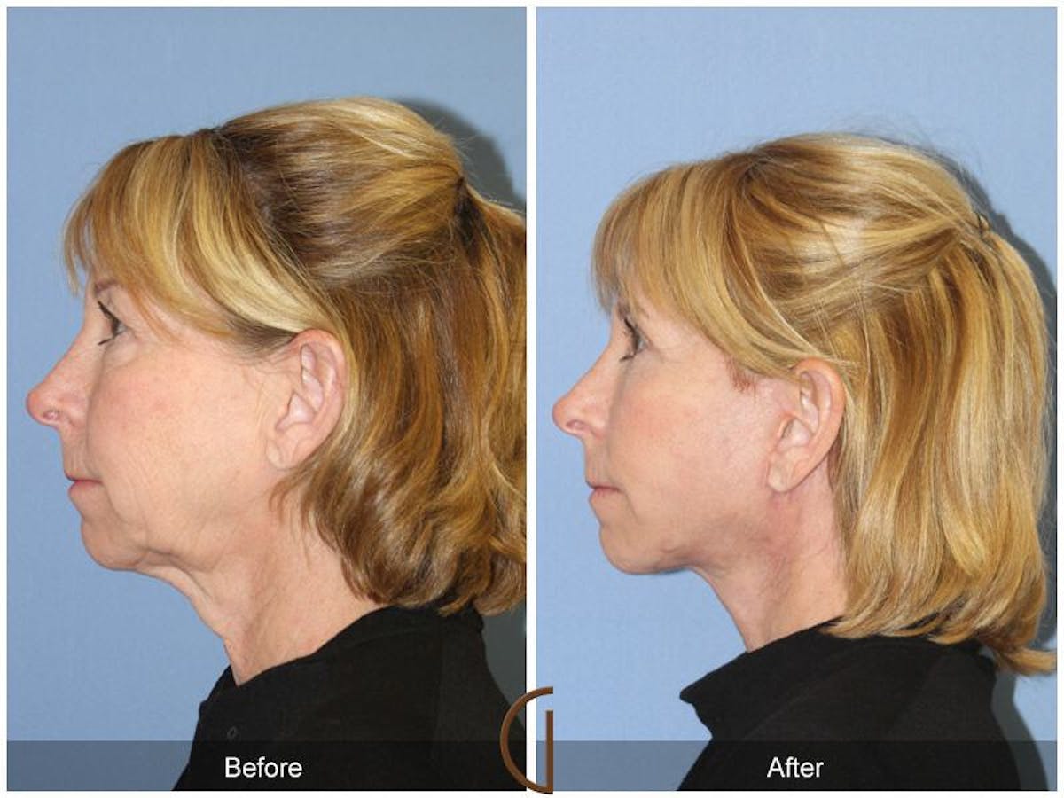 Facelift 60s Before & After Gallery - Patient 188895 - Image 1
