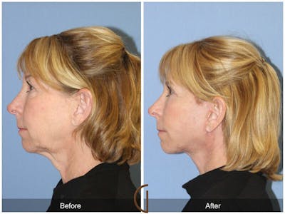 Neck Lift Before & After Gallery - Patient 420333 - Image 1