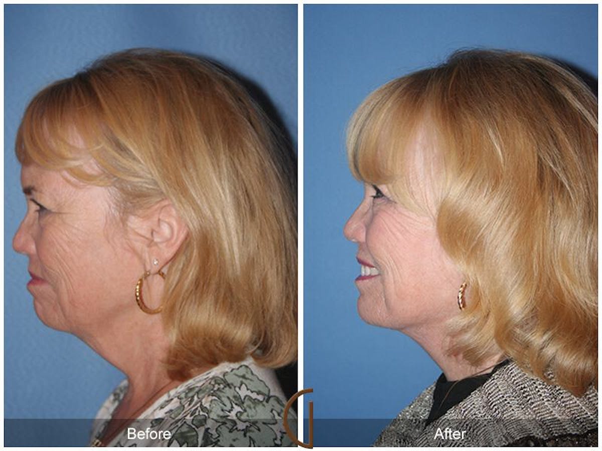 Facelift 60s Before & After Gallery - Patient 208533 - Image 1