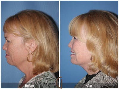 Neck Lift Before & After Gallery - Patient 186908 - Image 1