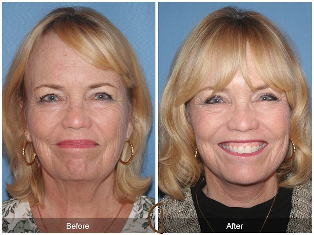 Facelift 60s Before & After Gallery - Patient 208533 - Image 2