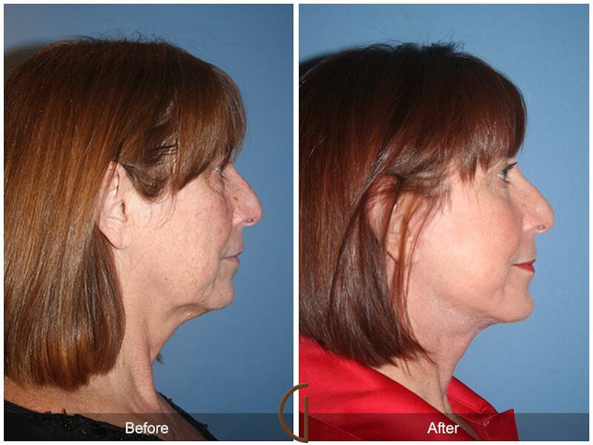 Facelift 60s Before & After Gallery - Patient 199819 - Image 3
