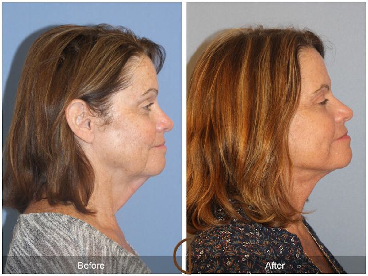 Facelift 60s Before & After Gallery - Patient 420234 - Image 3
