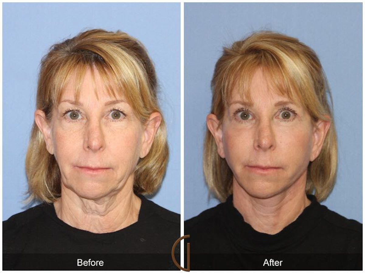Facelift 60s Before & After Gallery - Patient 188895 - Image 2