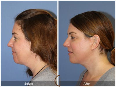 Neck Lift Before & After Gallery - Patient 254005 - Image 1