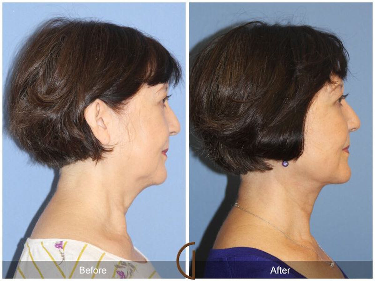 Facelift 60s Before & After Gallery - Patient 355368 - Image 3