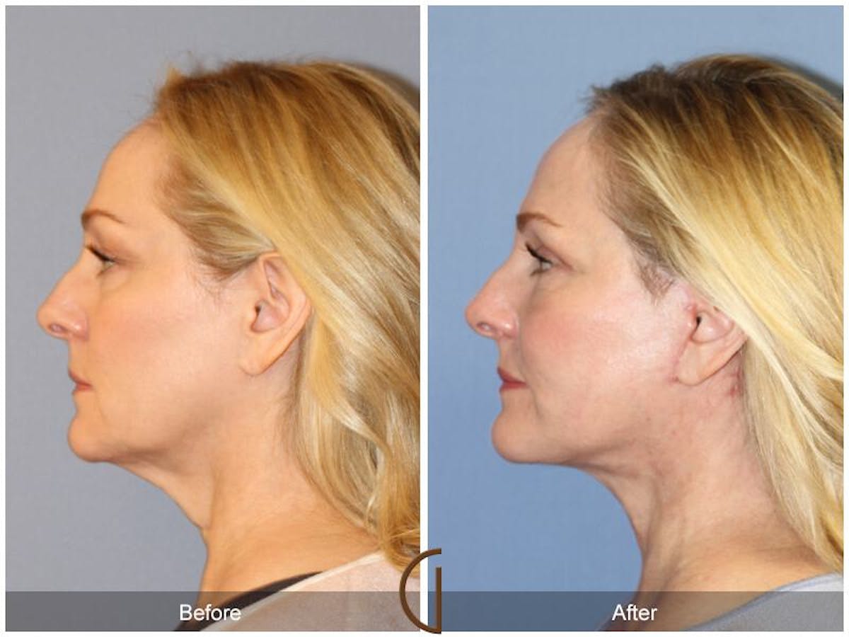 Facelift 40s Before & After Gallery - Patient 181445 - Image 1