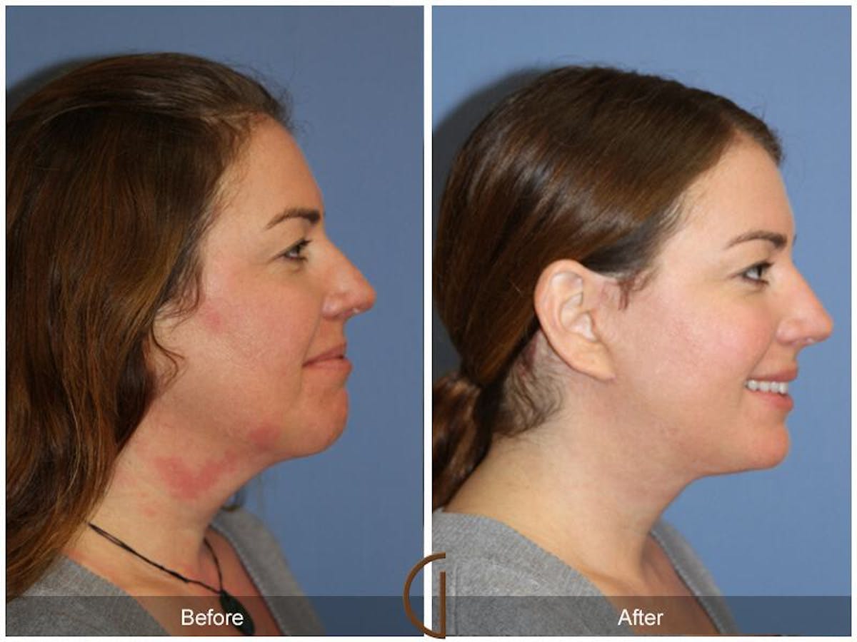 Facelift 40s Before & After Gallery - Patient 189446 - Image 3