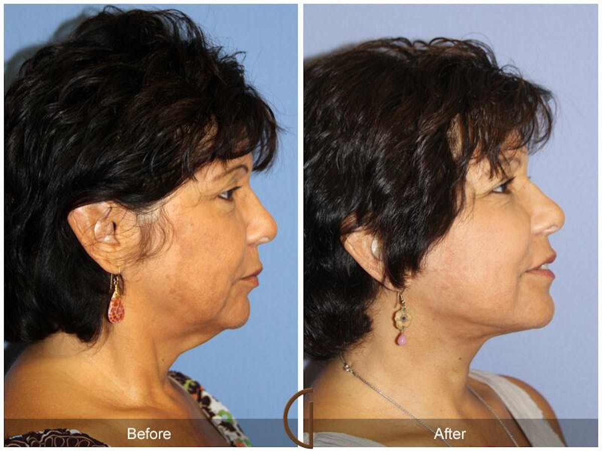Facelift 60s Before & After Gallery - Patient 209868 - Image 3
