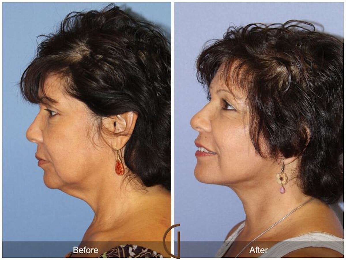 Facelift 60s Before & After Gallery - Patient 209868 - Image 1