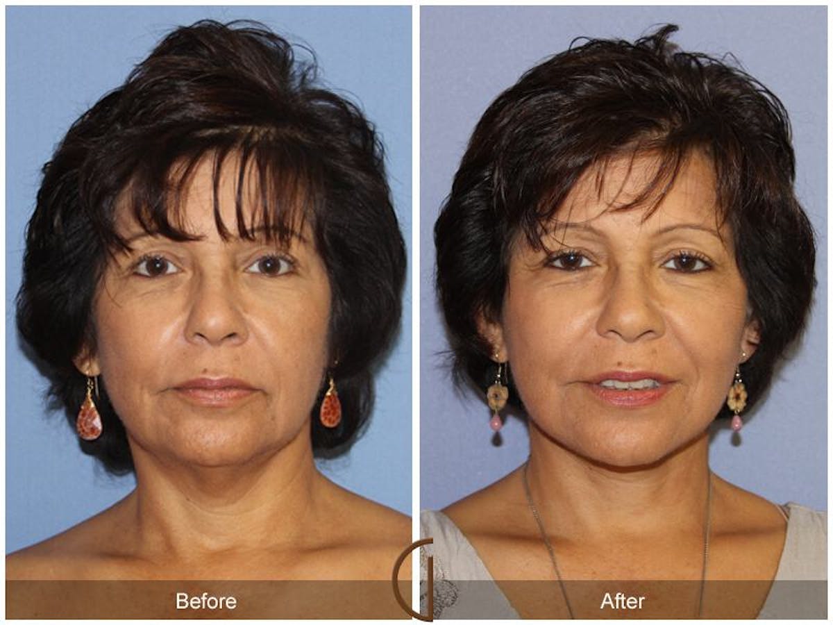Facelift 60s Before & After Gallery - Patient 209868 - Image 2