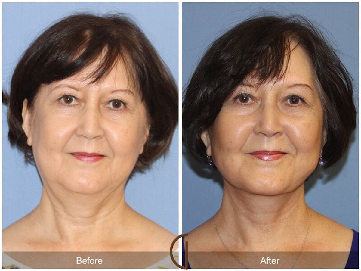 Facelift 60s Before & After Gallery - Patient 355368 - Image 2