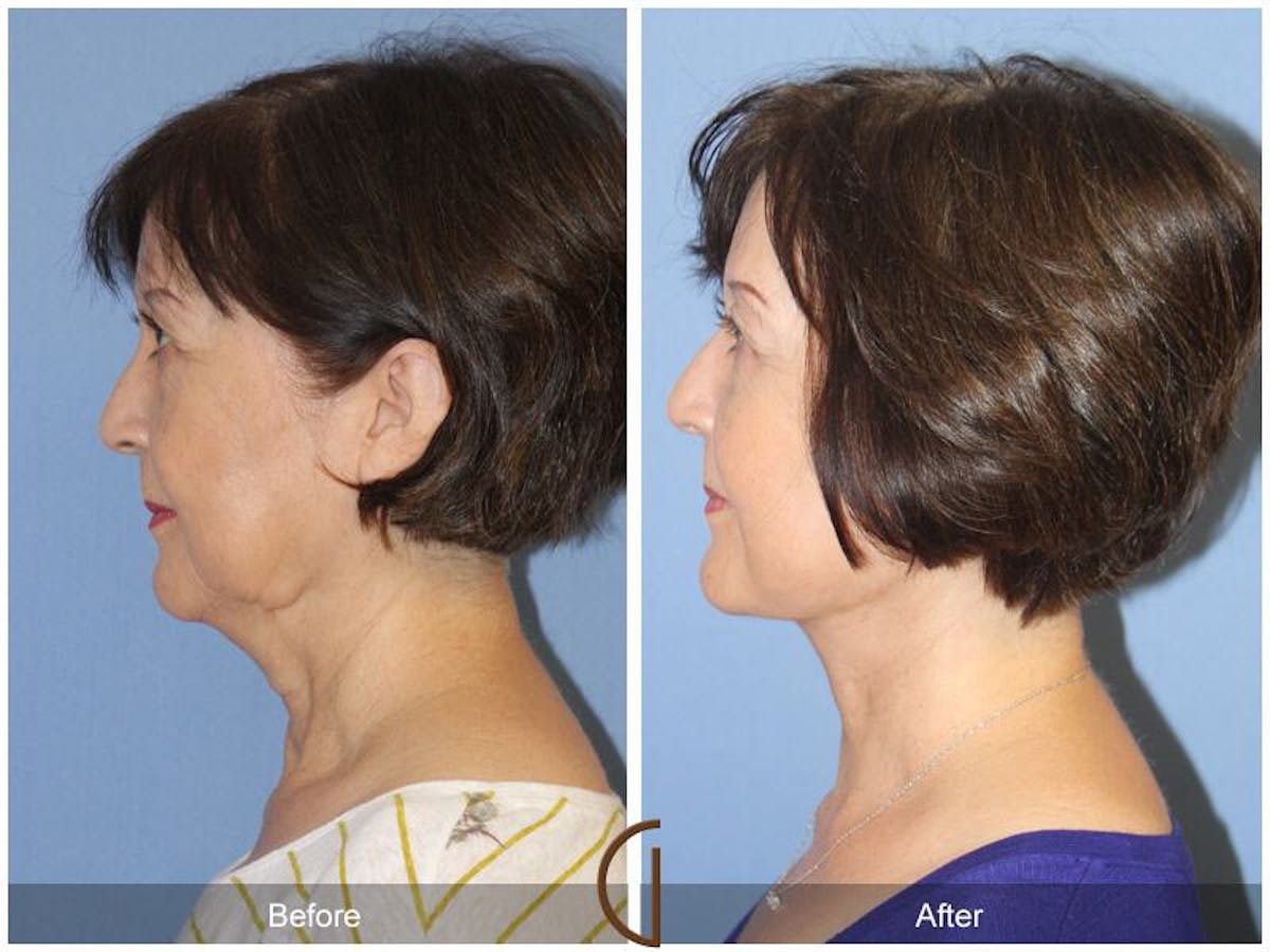 Facelift 60s Before & After Gallery - Patient 355368 - Image 1