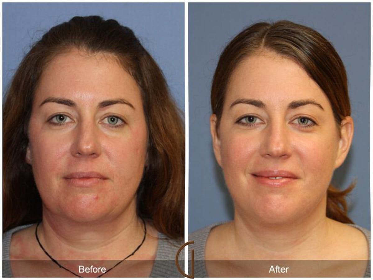 Facelift 40s Before & After Gallery - Patient 189446 - Image 2