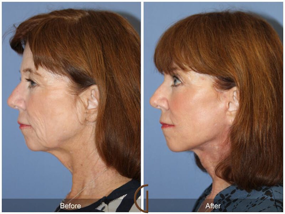 Facelift 60s Before & After Gallery - Patient 323670 - Image 1