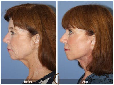 Neck Lift Before & After Gallery - Patient 118399 - Image 1