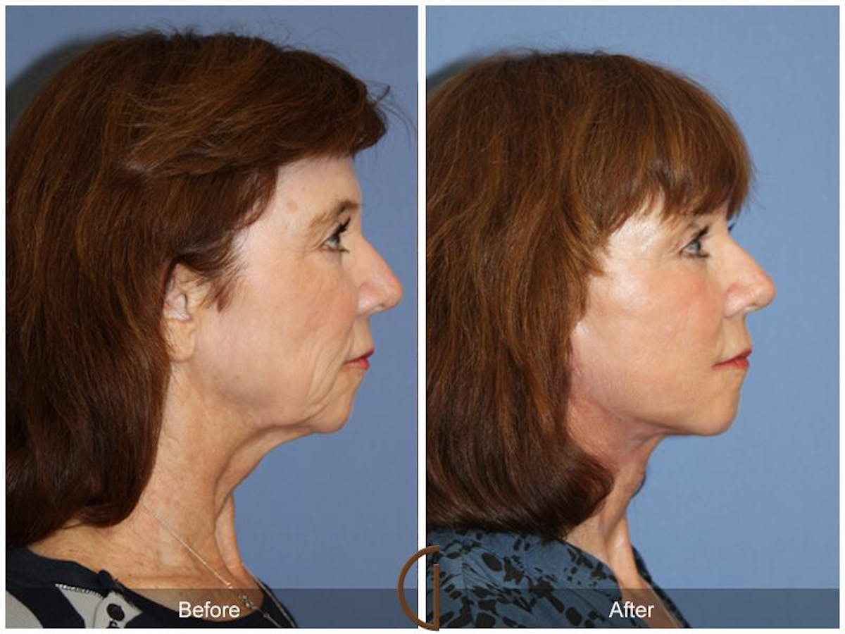 Facelift 60s Before & After Gallery - Patient 323670 - Image 3