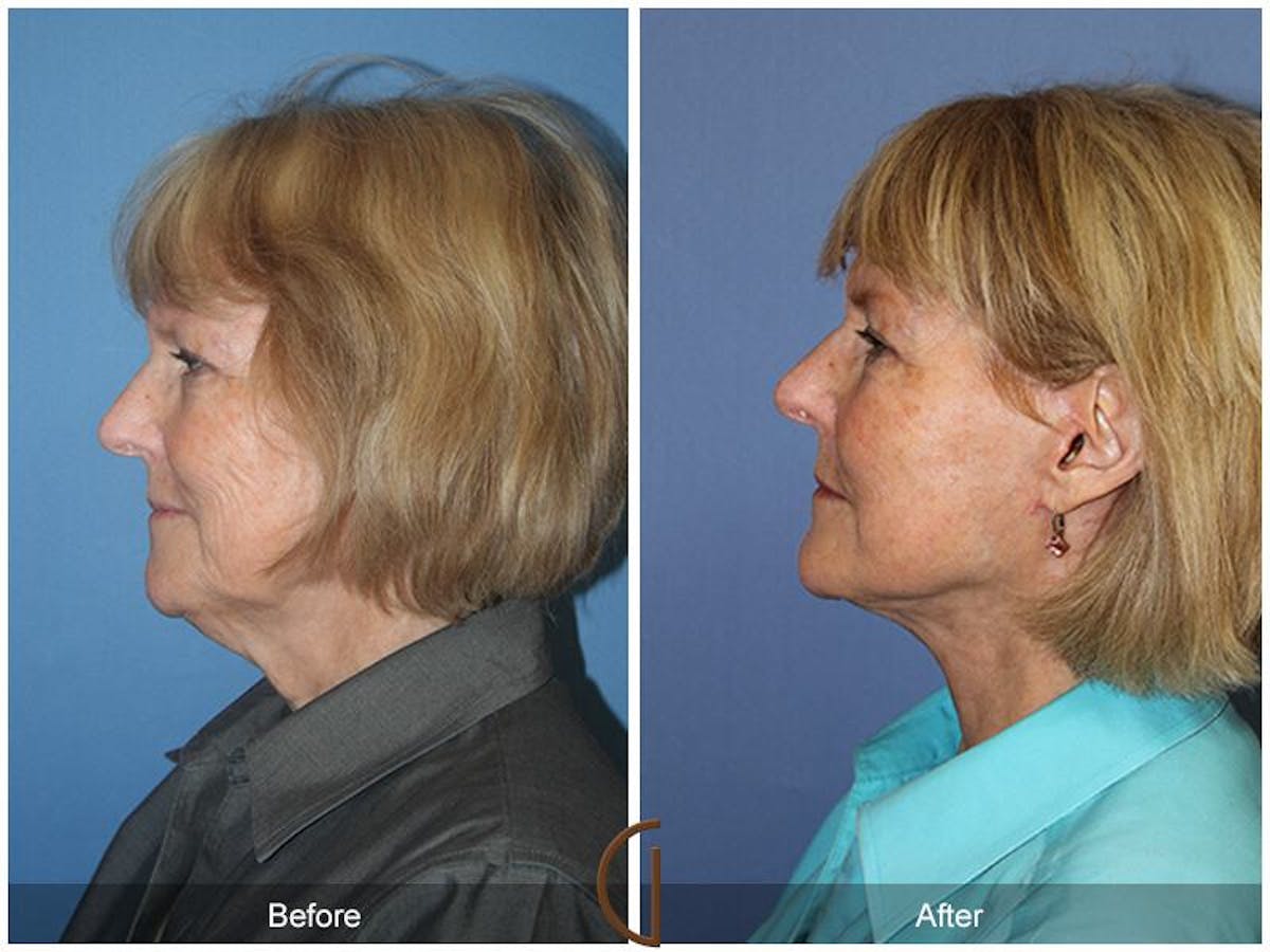 Facelift 60s Before & After Gallery - Patient 150585 - Image 1