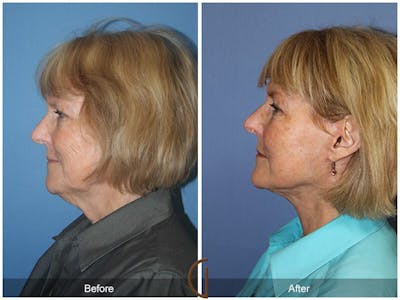 Neck Lift Before & After Gallery - Patient 391514 - Image 1