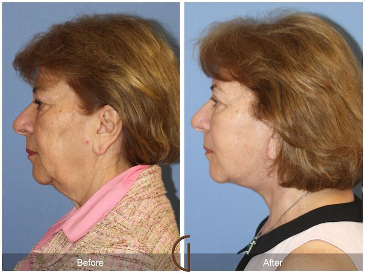 Facelift 60s Before & After Gallery - Patient 572852 - Image 1