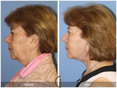 Neck Lift Before & After Gallery - Patient 639401 - Image 1