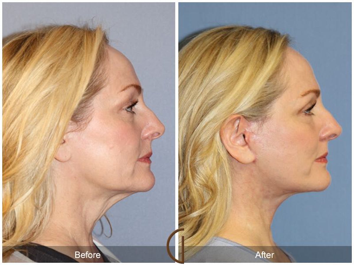 Facelift 40s Before & After Gallery - Patient 181445 - Image 3