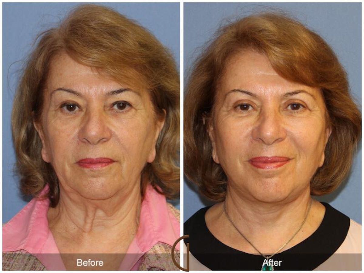 Facelift 60s Before & After Gallery - Patient 572852 - Image 2