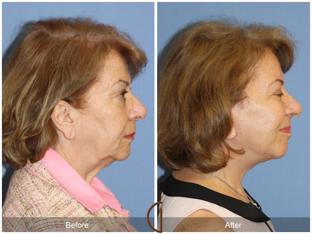 Facelift 60s Before & After Gallery - Patient 572852 - Image 3