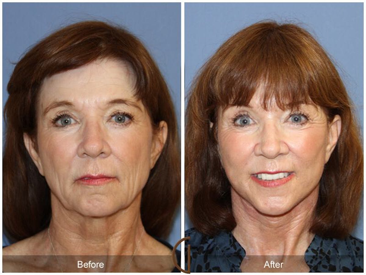 Facelift 60s Before & After Gallery - Patient 323670 - Image 2