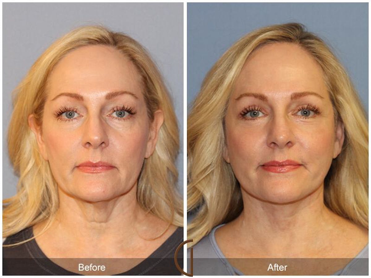Facelift 40s Before & After Gallery - Patient 181445 - Image 2