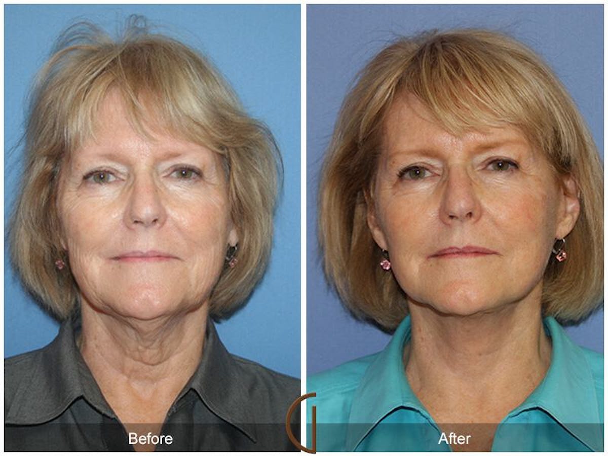 Facelift 60s Before & After Gallery - Patient 150585 - Image 2