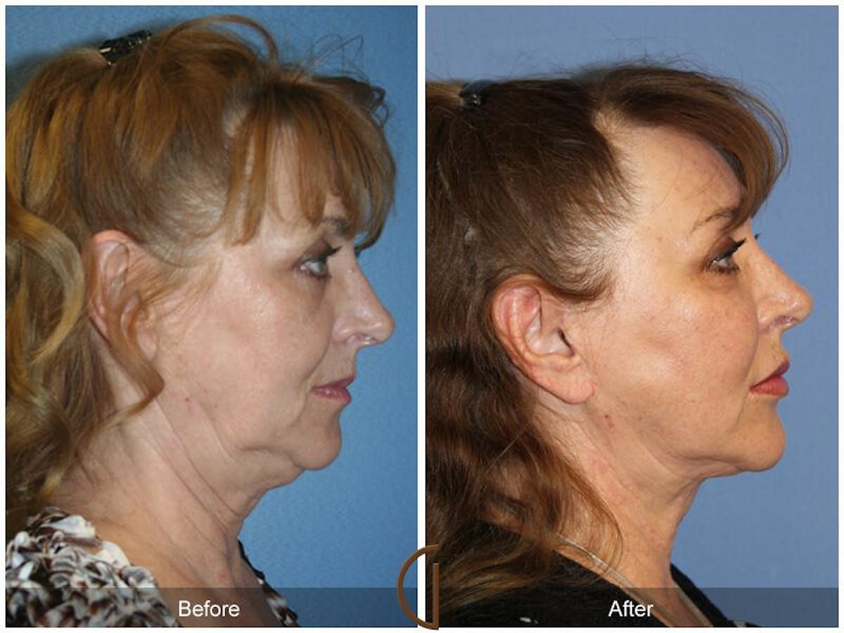 Facelift 60s Before & After Gallery - Patient 269397 - Image 3